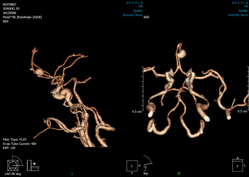 CT 혈관조영술상 뇌동맥류 발견