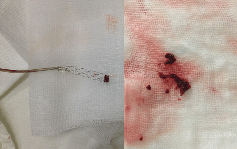 혈관내 수술 기법으로 혈관안에 있는 혈전을 제거견