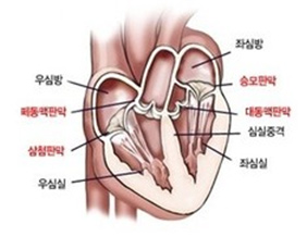 심장판막질환 사진