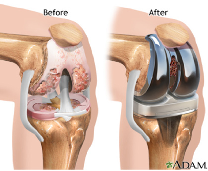 무릎 인공관절 치환술 사진