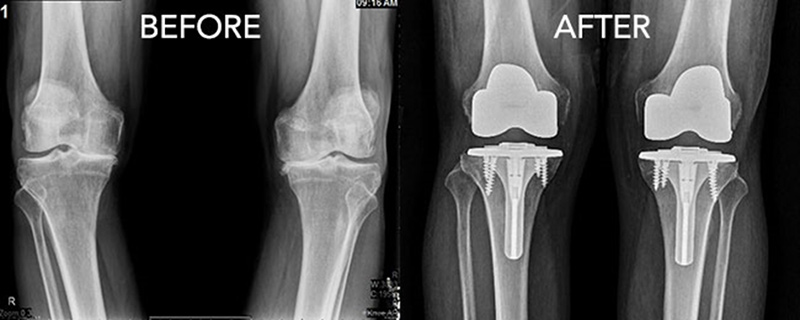 무릎 인공관절 치환술 사진
