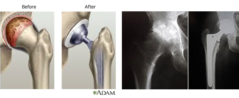 고관절 인공 관절 치환술 사진
