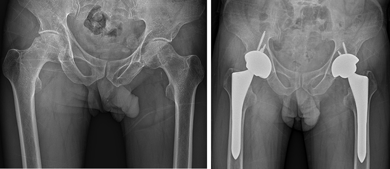 고관절 인공관절치환술 증례술 사진