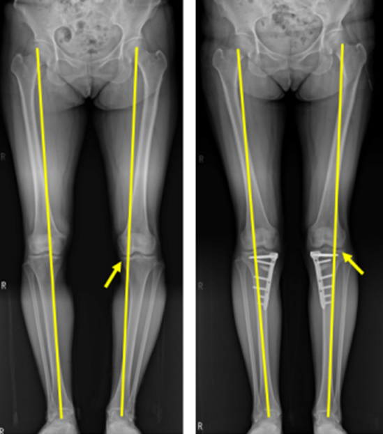 휜다리 교정술 증례 사진