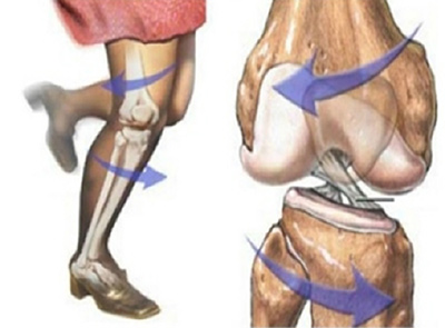 전방 십자인대 파열 사진