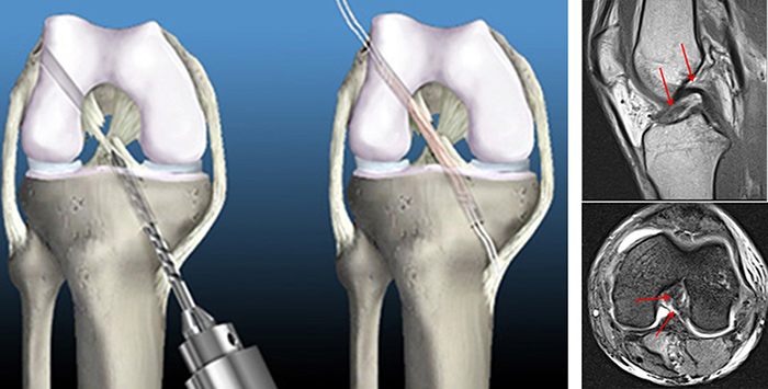 전방 십자인대 파열 사진
