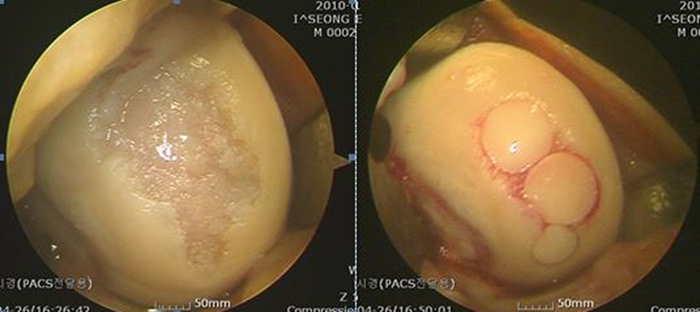 내시경 자가 연골 이식술 사진