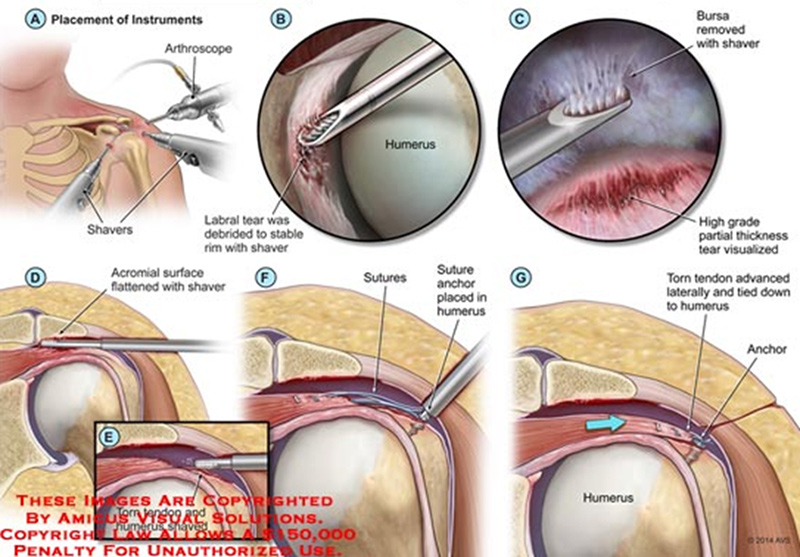 견봉 성형술과 회전근개 건 봉합술 사진
