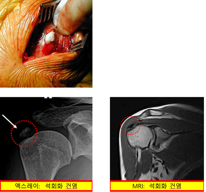 석회화 건염 사진