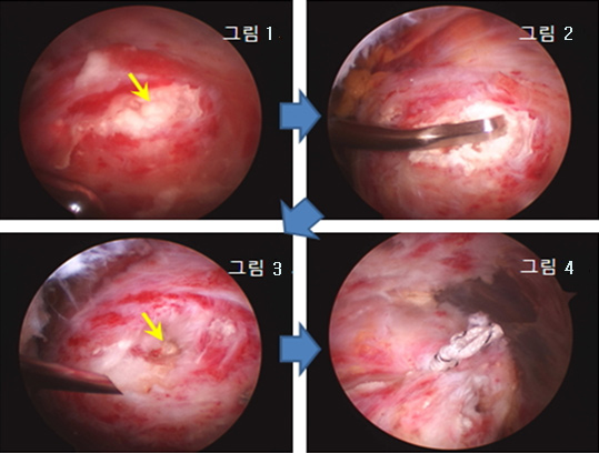 석회화 건염과 관절경적 석회제거술 사진