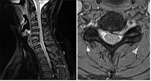 경추 추간판 탈출증