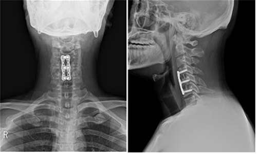 경추 추간판 탈출증