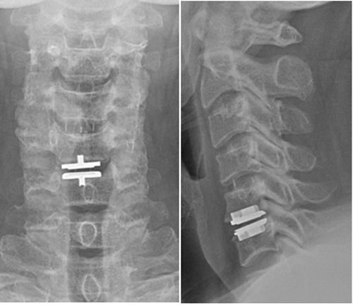 경추 추간판 탈출증