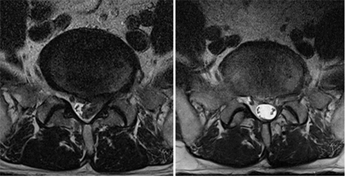디스크 내 열전기 치료, 수핵 용해술