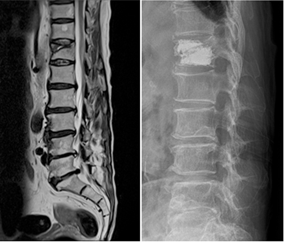 골다공증성 척추 압박 골절의 치료