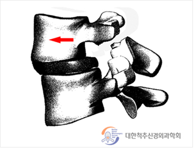 척추 전방 전위증