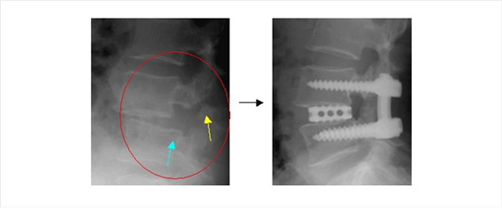 척추분리증으로 인한 척추전방전위증 환자의 수술전 사진