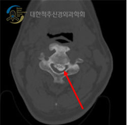 전산화 단층 촬영