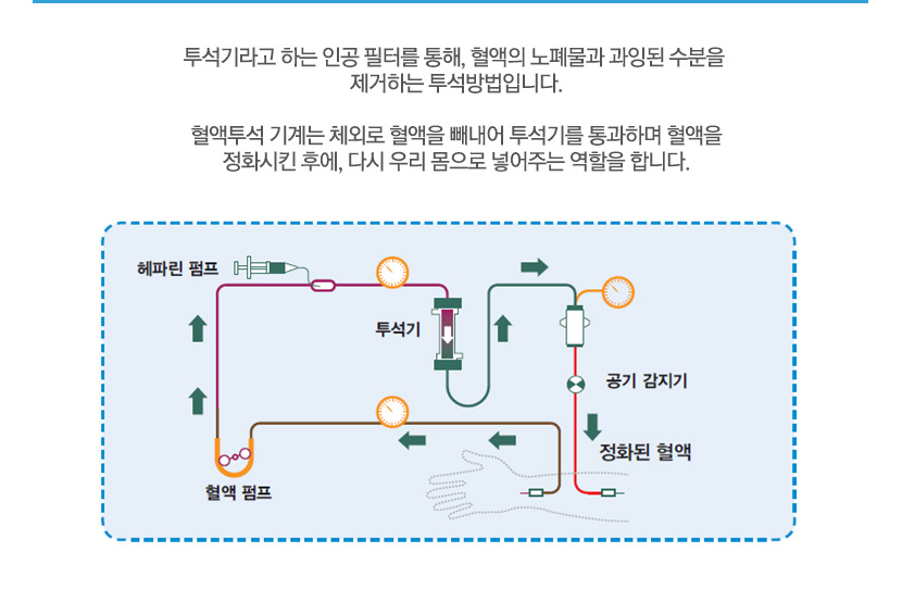 투석기라고 하는 인공 필터를 통해, 혈액의 노폐물과 과잉된 수분을 제거하는 투석방법입니다. 혈액투석 기계는 체외로 혈액을 빼내어 투석기를 통과하며 혈액을 정화시킨 후에, 다시 우리 몸으로 넣어주는 역할을 합니다.
