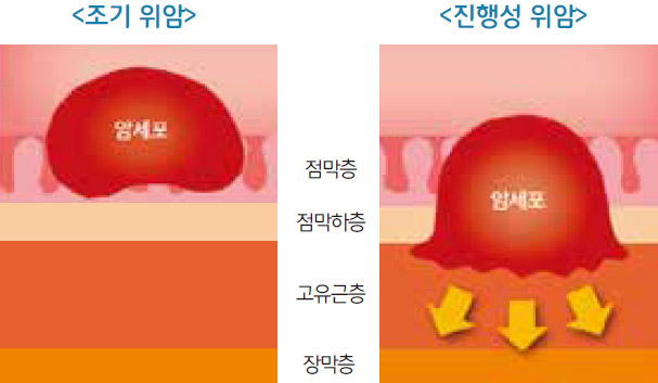 조기위암 / 진행성위암
