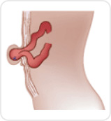 재대 탈장 그림