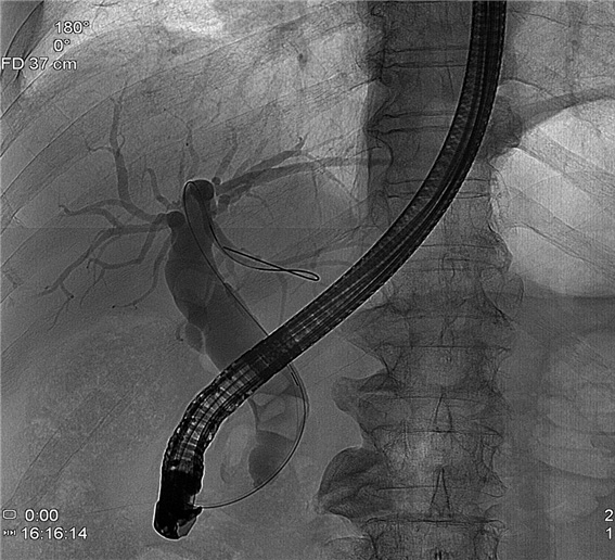 담도 조영술 검사상 관찰되는 담도 결석