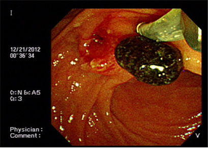 제거된 담도 결석