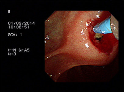 절개도(Kneedle knife)를 이용한 십이지장 유두부 절개술 시행