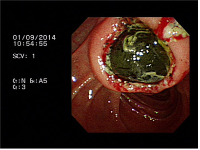 노출된 거대 담석