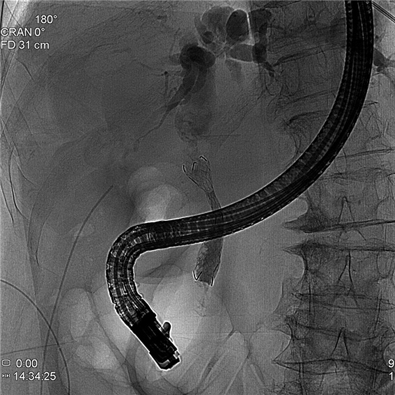 간외 담도암으로 인한 담도 협착 부위에 금속 배액관 시행