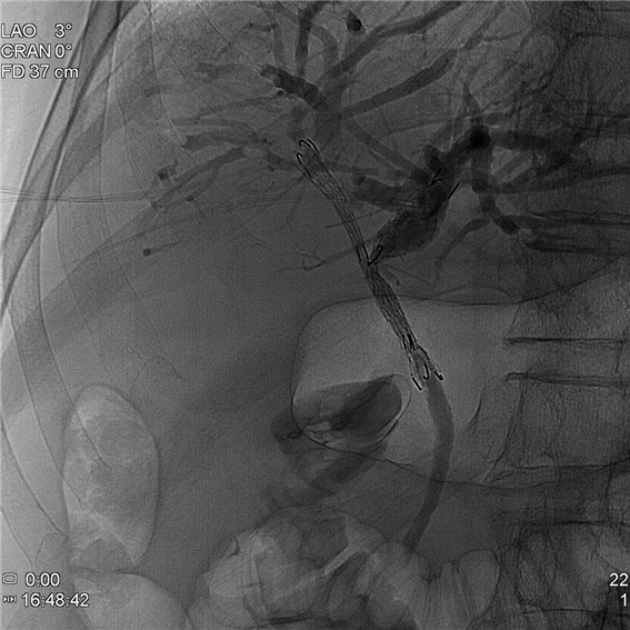 간문부 담도암으로 인한 협착 부위에 금속 스텐트 2 개를 이용하여 좌,우 간내 담도 배액술 시행