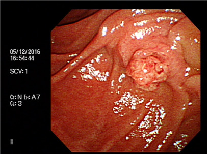 십이지장 유두부 종양