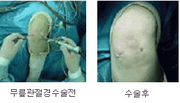 무릎관절경 수술전후사진