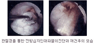 관절경을 통한 전방십자인대파열의 진단과 재건후의 모습