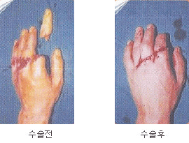 수술전후사진
