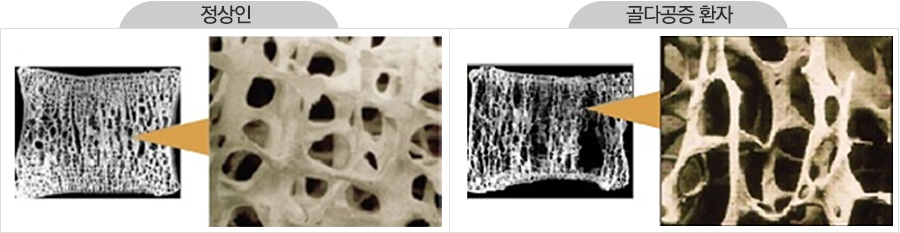 정상인과 골다공증 환자 비교 이미지