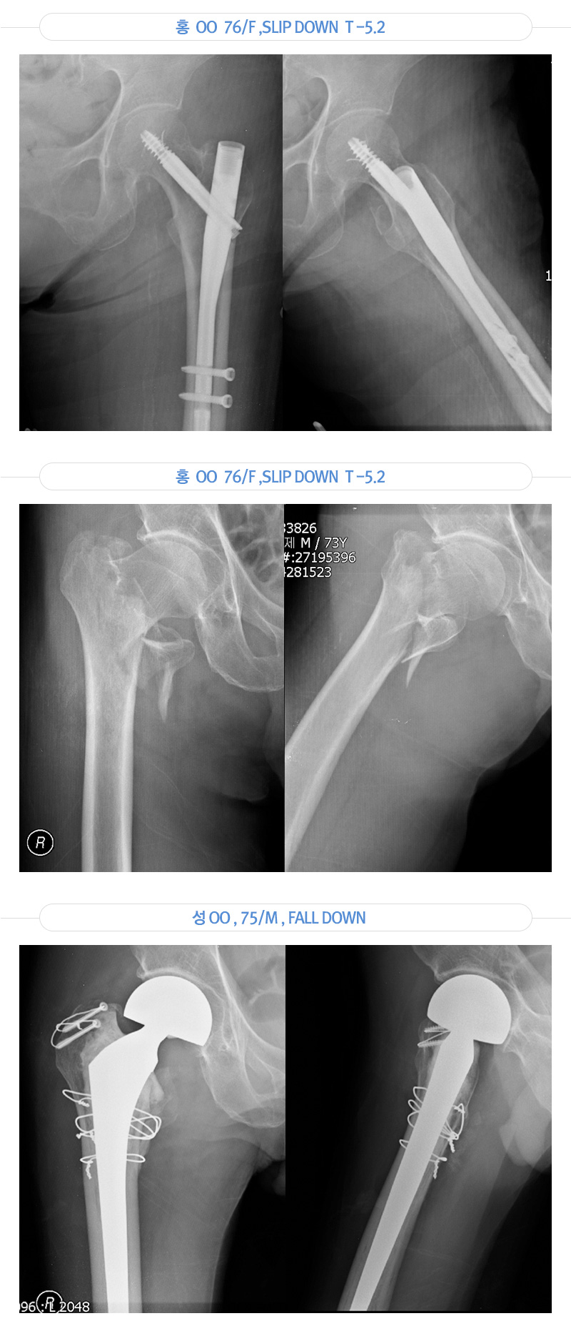 골다공증으로 인한 노인 골절 증례 이미지