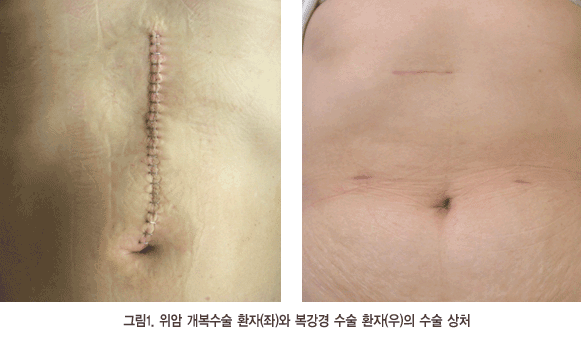 복강경수술사진