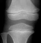 경골 열린경우 사진