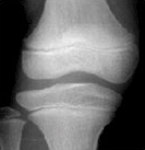 경골 닫혀가는 경우사진