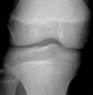 경골 닫힌 경우 사진