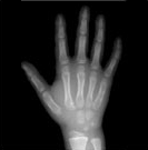 지골 열린경우 사진