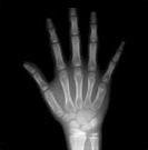 지골 닫혀가는 경우 사진