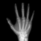 지골 닫힌 경우 사진