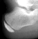 중골 열린경우 사진