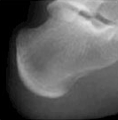 종골 닫힌 경우 사진