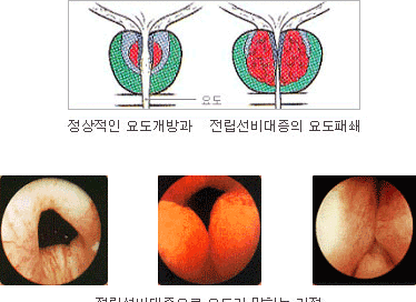 정상적인 요도개방과 전립선비대증의 요도패쇄사진