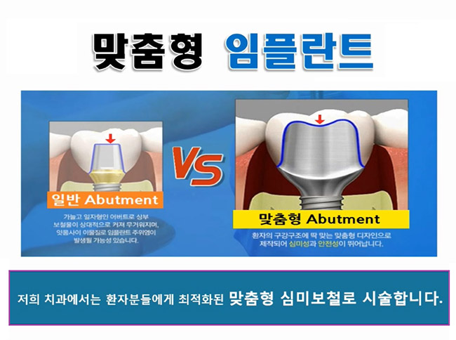 임플란트 수술 사진